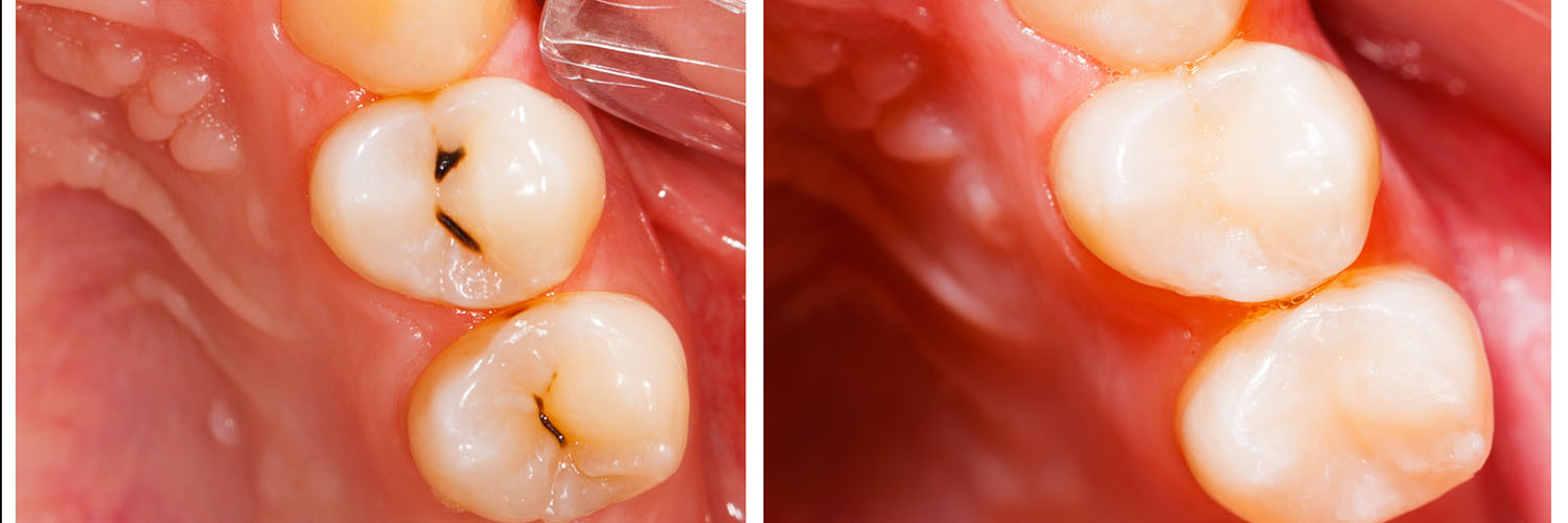 The image shows a close-up view of a person s teeth with visible cavities and a gumline, likely used for dental health education or demonstration purposes.